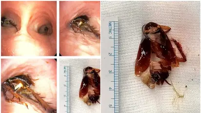 കടുത്ത ശ്വാസതടസം, കൊച്ചിയിൽ ചികിത്സ തേടിയെത്തിയ 55 കാരന്റ ശ്വാസകോശത്തിൽ നിന്ന് പുറത്തെടുത്തത് പാറ്റയെ...