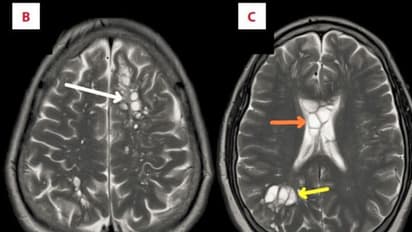 ಮೈಗ್ರೇನ್ ತಲೆನೋವು ಅಂತ ಆಸ್ಪತ್ರೆಗೆ ಹೋದವನಿಗೆ ಶಾಕ್: ಮೆದುಳಿನಲ್ಲಿ ಇದ್ದಿದ್ದೇನು ನೋಡಿ?