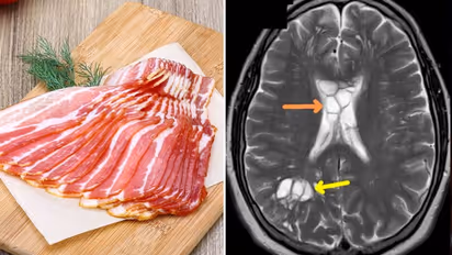 പാതിവേവിച്ച ഇറച്ചി കഴിച്ചു, പിന്നീട് വിട്ടുമാറാത്ത തലവേദന; പരിശോധനയിൽ ഞെട്ടി, തലച്ചോറില് മുട്ടയിട്ട് വിരകൾ