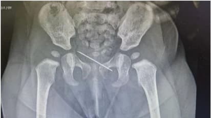 ചര്‍മ്മത്തിനടിയിൽ അസ്വസ്ഥത; പിഞ്ചു കുഞ്ഞിന് വിദഗ്ധ പരിശോധന, നീക്കം ചെയ്തത് 3.5 സെന്‍റീമീറ്റര്‍  നീളമുള്ള സൂചി