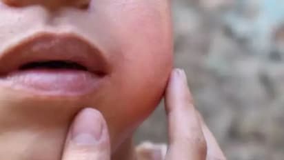 Mumps outbreak in Kerala, over 11,000 cases: What is mumps and its symptoms