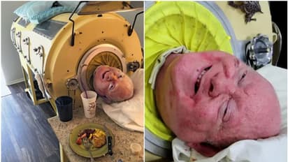 ഒമ്പതാം വയസ്സിൽ പോളിയോ ബാധിച്ചു, 70 വർഷം ഇരുമ്പ് ശ്വാസകോശത്തിനുള്ളിൽ ജീവിതം; പോളിയോ പോൾ അന്തരിച്ചു