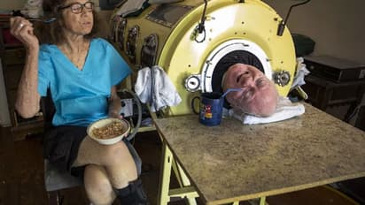 72 ವರ್ಷಗಳ ಕಾಲ ಲೋಹದ ಶ್ವಾಸಕೋಶವೇ ಬದುಕು;  ಮಲಗಿದಲ್ಲಿಂದಲೇ ಸಾಧಿಸಿ ತೋರಿಸಿದ್ದ ಪಾಲ್ ನಿಧನ