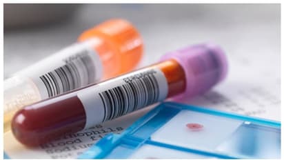 ஆண்களே ப்ளீஸ்;  ஆண்டுக்கு ஒருமுறை கண்டிப்பா இந்த 5 ரத்த பரிசோதனைகளை செய்யுங்க!