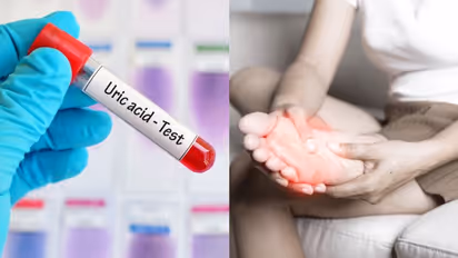 യൂറിക് ആസിഡ് കുറയ്ക്കാന് ഡയറ്റില് ഉള്പ്പെടുത്താം ഈ ആറ് ഭക്ഷണങ്ങള്...