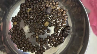 60 വയസുള്ള രോഗിയുടെ വൃക്കയില് നിന്ന് ഡോക്ടര്മാര് നീക്കിയത് 418 കല്ലുകള്