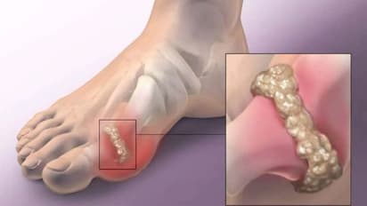 യൂറിക് ആസിഡ് കുറയ്ക്കാന് ഡയറ്റില് ഉള്പ്പെടുത്താം ഈ നട്സും ഡ്രൈ ഫ്രൂട്ട്സും...