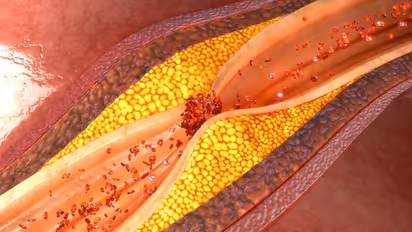 ഉയർന്ന കൊളസ്ട്രോൾ കുറയ്ക്കാൻ വീട്ടിലുണ്ട് നാല് പ്രതിവിധികൾ 