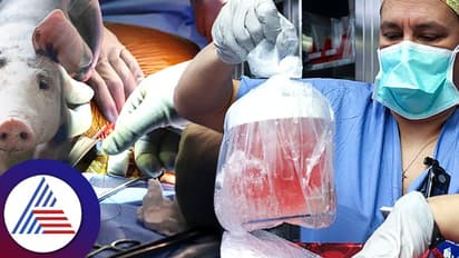 Kidney Transplant : ಇದೇ ಮೊದಲ ಬಾರಿ ಮನುಷ್ಯನಿಗೆ ಕಸಿಯಾಯ್ತು ಹಂದಿ ಕಿಡ್ನಿ