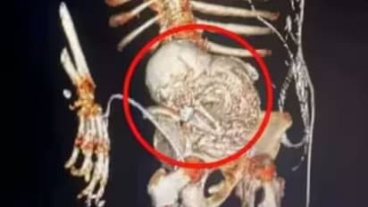 56 വർഷം വയറ്റില്‍ ചുമന്നത് 'സ്റ്റോണ്‍ ബേബി'യെ; സർജറിക്ക് പിന്നാലെ 81 -കാരിക്ക് ദാരുണാന്ത്യം