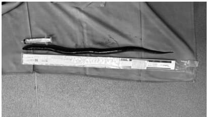 34കാരന് കഠിനമായ വയറുവേദന; സ്കാൻ ചെയപ്പോൾ12 ഇഞ്ച് നീളമുള്ള ഈൽ, മലദ്വാരത്തിലൂടെ ശരീരത്തിലെത്തിയതെന്ന് അനുമാനം