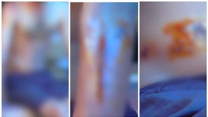 ചേലക്കരയിൽ കാട്ടുപന്നി ആക്രമണം; ഇരുചക്രവാഹന യാത്രികർക്ക് പരിക്കേറ്റു