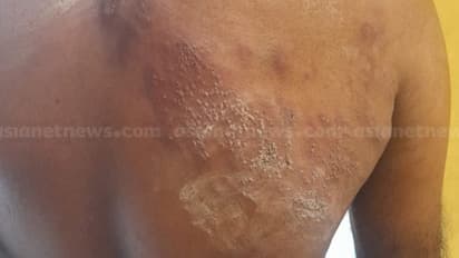 കൊടും വെയിലിൽ തെരഞ്ഞെടുപ്പ് പ്രചാരണം: കോൺഗ്രസ് പ്രവര്ത്തകന് സൂര്യാഘാതമേറ്റു, ആശുപത്രിയിൽ പ്രവേശിപ്പിച്ചു