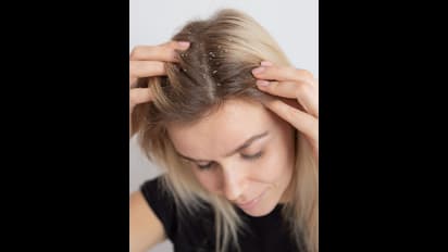 Dandruff remedies: பொடுகுத்தொல்லை இனி இல்லவே இல்லை; சிம்பிள் வீட்டு டிப்ஸ்!!