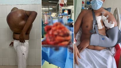 വമ്പൻ ആശുപത്രികൾ കൈവിട്ടു, 24കാരനെ ധൈര്യത്തോടെ ഏറ്റെടുത്ത് കോട്ടയം മെഡി. കോളജ്; 43 കിലോ ഭാരം, ട്യൂമർ നീക്കി