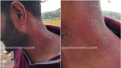 മലപ്പുറത്ത് വീട്ടുവളപ്പില് ജോലി ചെയ്യുന്നതിനിടെ യുവാവിന് സൂര്യാഘാതമേറ്റു