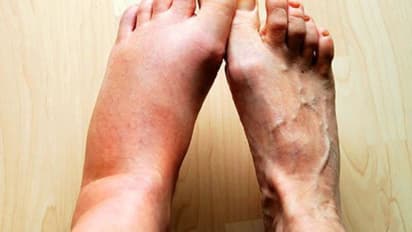 ശരീരത്തിലെ വീക്കം കുറയ്ക്കാൻ സഹായിക്കുന്ന അഞ്ച് പച്ചക്കറികൾ...