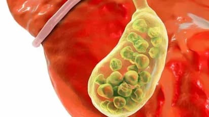 കൊളസ്ട്രോള് കുറയ്ക്കാന് വീട്ടില് ചെയ്യാവുന്ന കാര്യങ്ങള്...
