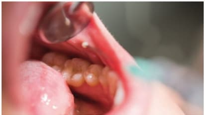 വായിലെ ക്യാൻസർ ; ആറ് ലക്ഷണങ്ങൾ അവഗണിക്കരുത്