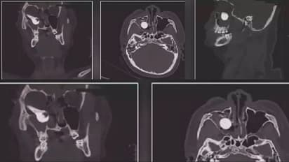 ಅಪಘಾತದ ವೇಳೆ ಕಣ್ಣಿನೊಳಗೆ ನುಗ್ಗಿದ ಬೈಕ್ನ ಬ್ರೇಕ್ ಹ್ಯಾಂಡಲ್ ಹೊರತೆಗೆದ ವೈದ್ಯರು