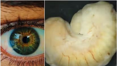 മുതലയിറച്ചി സ്ഥിരമായി കഴിച്ചത് പണിയായി, രണ്ട് വർഷമായി സ്ത്രീയുടെ കണ്ണിൽ വളർന്നത് ആർമിലിഫർ ഗ്രാൻഡിസ്