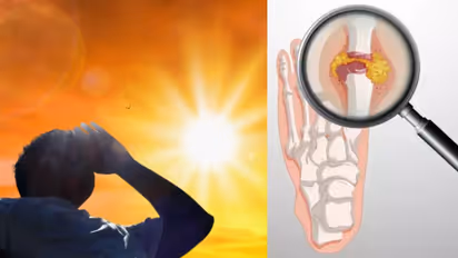 ചൂട് കൂടുമ്പോൾ ശരീരത്തില് യൂറിക്ക് ആസിഡ് കൂടാം; അറിയാം ഈ ലക്ഷണങ്ങളും ശ്രദ്ധിക്കേണ്ട കാര്യങ്ങളും...