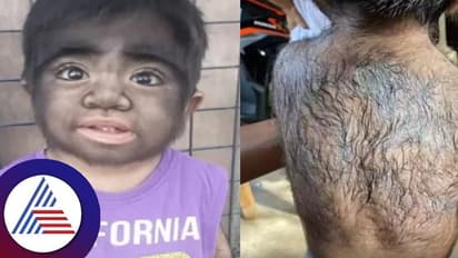 ಜಗತ್ತಲ್ಲೇ ಅತಿ ಹೆಚ್ಚು ರೋಮಭರಿತ ಮಗು ಇದು; ಇದೇನು ಸಮಸ್ಯೆ? ಕಾರಣವೇನು?