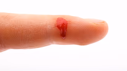 Customer bites off shopkeeper's finger in dispute over Rs 50 and frock exchange in Uttar Pradesh's Banda