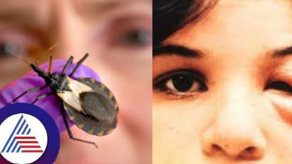 ಚಾಗಸ್ ರೋಗಕ್ಕೆ ವಾರ್ಷಿಕ 12 ಸಾವಿರ ಸಾವು; ಏನಿದು ಕಾಯಿಲೆ?