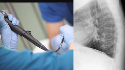  2 വയസുകാരിക്ക് അപസ്മാരമെന്ന് കരുതി, സ്കാനിങ്ങിൽ കാര്യമറിഞ്ഞു, ശ്വാസനാളത്തിൽ കണ്ടത് 1 മാസം പഴക്കമുള്ള കടല