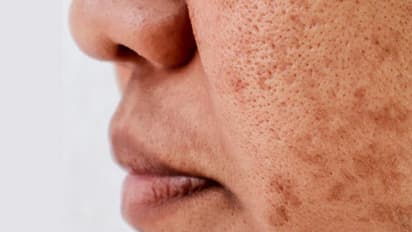 आपके किचन में मौजूद 5 चीज़ों से दूर होगी झाइयां, आज से शुरू कर दे इलाज