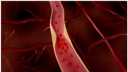 ഹൃദയത്തിൽ ബ്ലോക്ക് ;  ശരീരം കാണിക്കുന്ന പ്രധാനപ്പെട്ട ചില ലക്ഷണങ്ങൾ 