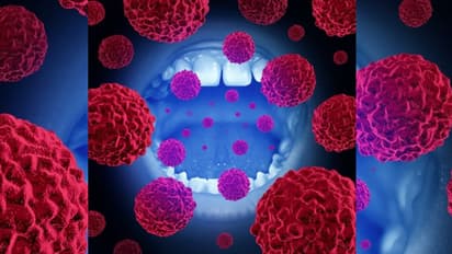 വായിലെ ക്യാന്‍സര്‍; തുടക്കത്തിലെ കാണിക്കുന്ന ഈ ലക്ഷണങ്ങളെ അവഗണിക്കരുതേ...