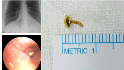 44 കാരിയുടെ ശ്വാസകോശത്തിൽ നിന്ന് കണ്ടെത്തിയത് 12 വർഷം മുൻപ് കാണാതായ മൂക്കുത്തിയുടെ ചങ്കിരി