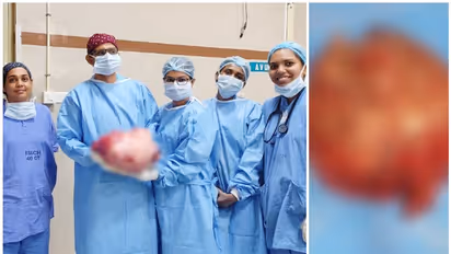 വീര്‍ത്ത വയറുമായെത്തിയ യുവതി; 36 സെ.മീ നീളം, 33 സെ.മീ വീതിയുമുള്ള രക്തയോട്ടം കൂടുതലുള്ള മുഴ, നീക്കം ചെയ്തു