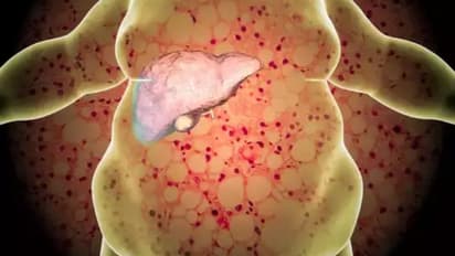 മുഖത്ത് കാണുന്ന ഈ ലക്ഷണങ്ങളെ അവഗണിക്കേണ്ട, ഫാറ്റി ലിവര് രോഗത്തിന്റെയാകാം