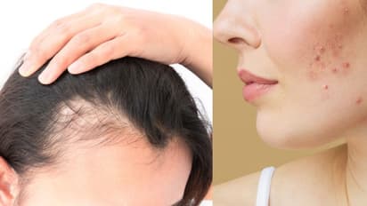 രുചിയും മണവും നഷ്ടപ്പെടുക, ഒപ്പം തലമുടി കൊഴിച്ചിലും വരണ്ട ചര്‍മ്മവും മുഖക്കുരുവും; ഈ പോഷകത്തിന്‍റെ കുറവാകാം