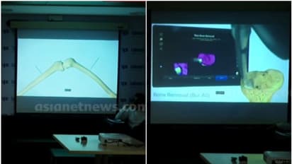 എഐ റോബോട്ടിക് സാങ്കേതിക വിദ്യ; കാൽമുട്ട് മാറ്റിവയ്ക്കൽ ശസ്ത്രക്രിയയിൽ മുന്നേറ്റം