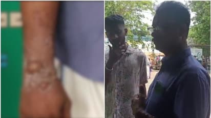 നിലമ്പൂരില് യാത്രയ്ക്കിടെ 53കാരന് സൂര്യാഘാതമേറ്റു; കൈകളിലും വയറിലും പൊള്ളി കുമിളകള്