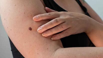 Health Tips: ശരീരം മുൻകൂട്ടി കാണിക്കുന്ന ഈ അഞ്ച് സൂചനകളെ അവഗണിക്കരുത്, ത്വക്കിലെ അര്ബുദമാകാം