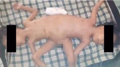 1 in 2 million case: Rare Indonesian conjoined twins, born with 4 arms & 3 legs, undergo surgical correction