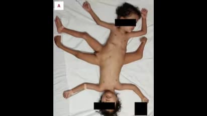 4 ಕೈ, 3 ಕಾಲಿನ ಜೊತೆ ಹುಟ್ಟಿದ್ದ ಸಯಾಮಿ ಅವಳಿಗಳಿಗೆ ನಡೀತು ಶಸ್ತ್ರಚಿಕಿತ್ಸೆ; ಈಗ ಹೇಗಿದ್ದಾರೆ?