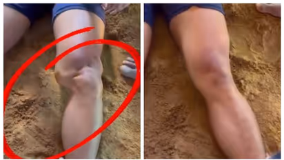 തെന്നിപ്പോയ മുട്ടുചിരട്ട വെറും കൈ ഉപയോഗിച്ച് ശരിയാക്കിയിടുന്ന വീഡിയോ ഏറ്റെടുത്ത് സോഷ്യല്‍ മീഡിയ