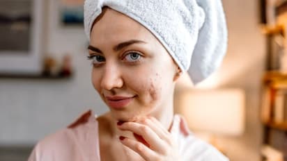 മുഖക്കുരുവിനെ തടയാന്‍ ഡയറ്റില്‍ നിന്നും ഒഴിവാക്കേണ്ട ഏഴ് ഭക്ഷണങ്ങള്‍