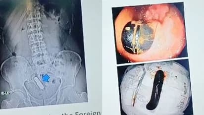 ಕಾಮತೃಷೆಗಾಗಿ ಗುದದ್ವಾರದಲ್ಲಿ ಸೆಕ್ಸ್ ಟಾಯ್ ತೂರಿಸಿಕೊಂಡಿದ್ದ 45ರ ವ್ಯಕ್ತಿ, ಸರ್ಜರಿ ಮೂಲಕ ಹೊರತೆಗೆದ ವೈದ್ಯರು!