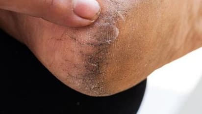 गर्मी हो या सर्दी नहीं फटेंगी एड़ियां, आज ही फॉलो करें ये टिप्स