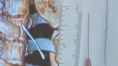 உடைமாற்றும் போது ஊசியை விழுங்கிய சிறுமி.. 3.5 நிமிடங்களில் அகற்றி தஞ்சை மருத்துவர்கள் சாதனை..