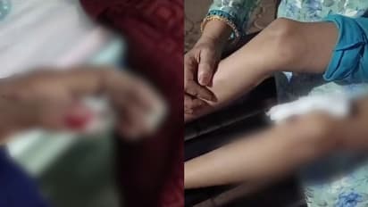 കോഴിക്കോട് തെരുവുനായയുടെ ആക്രമണം; 8 വയസുകാരിയടക്കം രണ്ട് പേർക്ക് കടിയേറ്റു