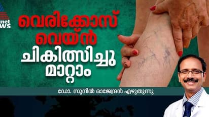 വെരിക്കോസ് വെയ്ന്‍ കൊണ്ടുനടക്കേണ്ട, ചികിത്സിച്ചു മാറ്റാം; ഡോക്ടര്‍ എഴുതുന്നു