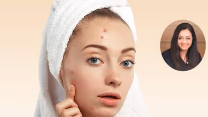 முகத்தில் உள்ள ஒவ்வொரு பருக்களுக்கும் வெவ்வேறு பின்னணி உண்டு தெரியுமா? எங்கு வந்தால் என்ன அர்த்தம்?